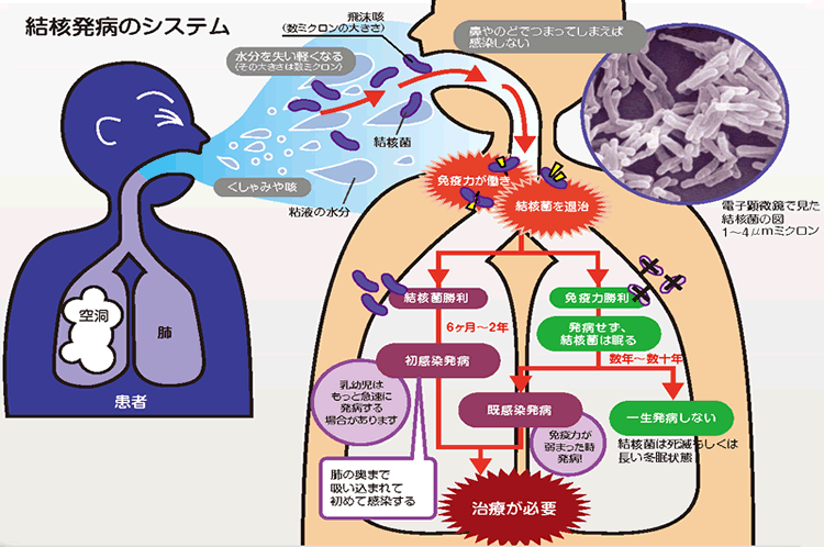 結核発病のシステム